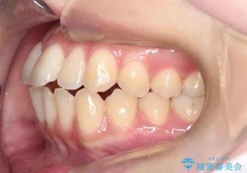 前歯のデコボコと突出を、目立たない矯正で解消の治療前