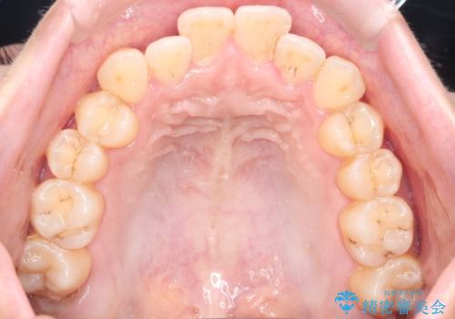 前歯のデコボコと突出を、目立たない矯正で解消の治療前