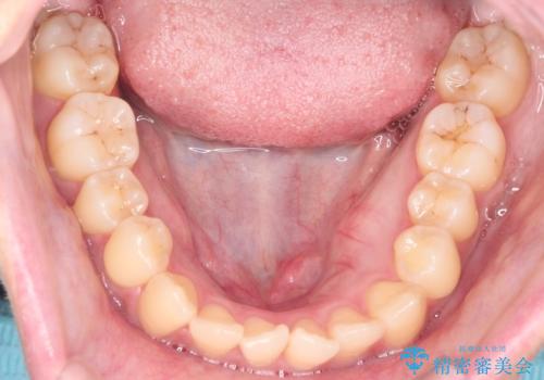前歯のデコボコと突出を、目立たない矯正で解消の治療前