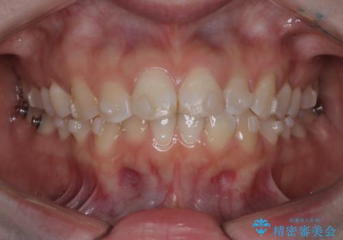 前歯のデコボコを、目立たない矯正で解消の治療中