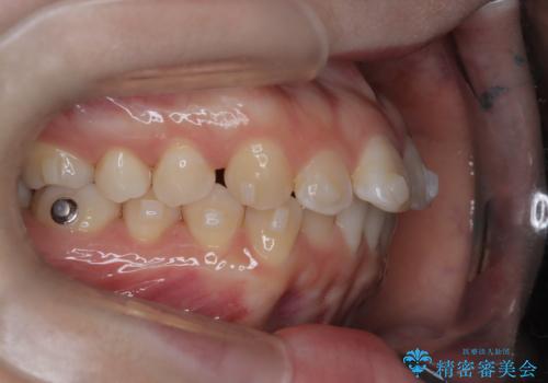 前歯のデコボコを、目立たない矯正で解消の治療中