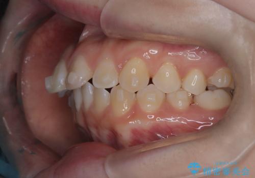 前歯のデコボコを、目立たない矯正で解消の治療中