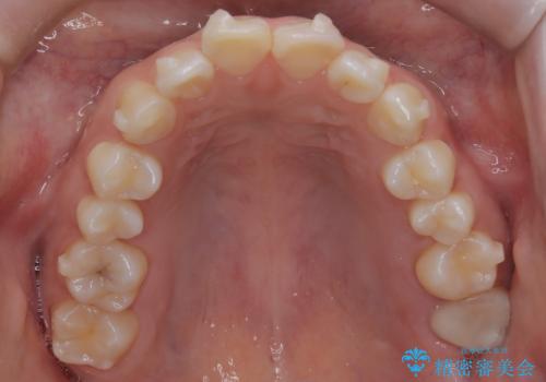 前歯のデコボコを、目立たない矯正で解消の治療中