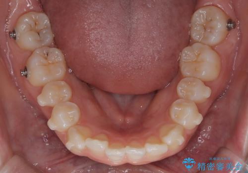 前歯のデコボコを、目立たない矯正で解消の治療中