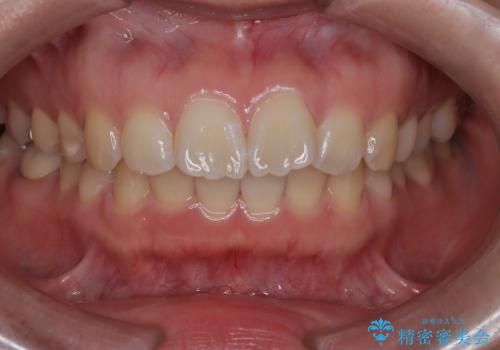 目立たない矯正で口元の突出感を解消の治療前