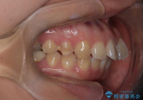 目立たない矯正で口元の突出感を解消の治療前