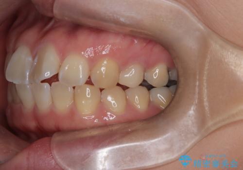 目立たない矯正で口元の突出感を解消の治療前