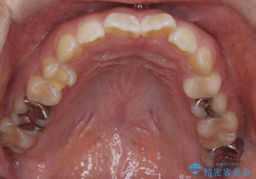 目立たない矯正で口元の突出感を解消の治療前