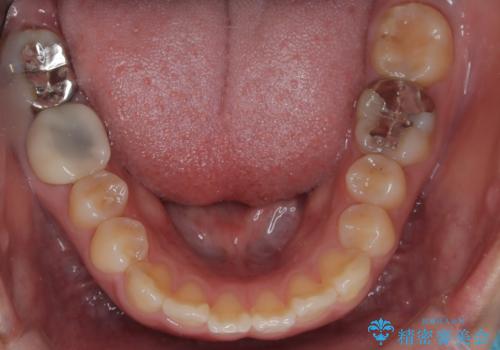 目立たない矯正で口元の突出感を解消の治療前