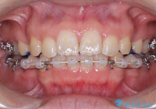 目立たない矯正で口元の突出感を解消の治療中