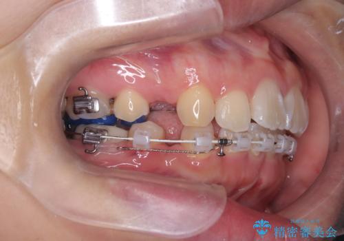 目立たない矯正で口元の突出感を解消の治療中