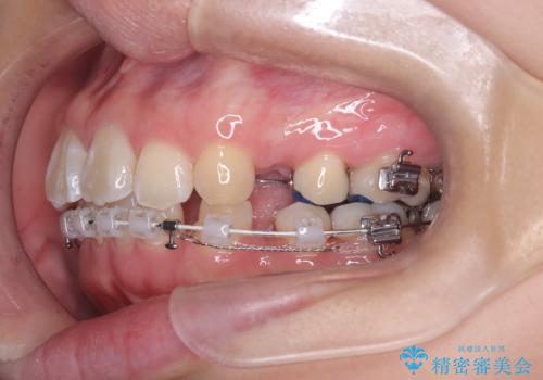 目立たない矯正で口元の突出感を解消の治療中