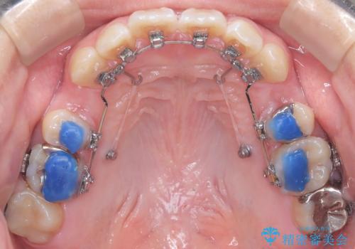 目立たない矯正で口元の突出感を解消の治療中