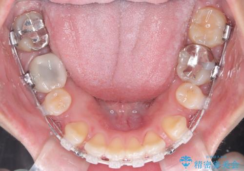 目立たない矯正で口元の突出感を解消の治療中