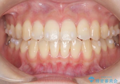 前歯のデコボコと突出を、目立たない矯正で解消の治療中