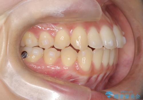 前歯のデコボコと突出を、目立たない矯正で解消の治療中