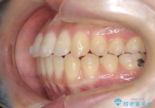 前歯のデコボコと突出を、目立たない矯正で解消の治療中