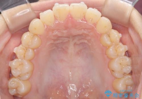 前歯のデコボコと突出を、目立たない矯正で解消の治療中