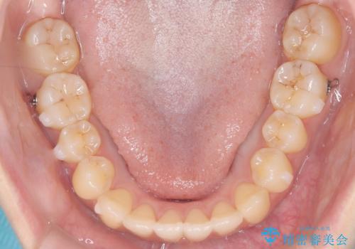 前歯のデコボコと突出を、目立たない矯正で解消の治療中