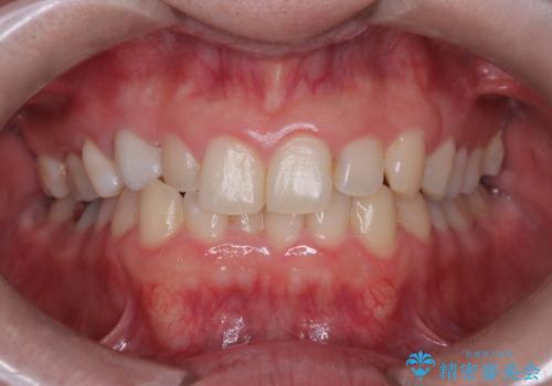 マウスピースで歯並びを改善の治療前