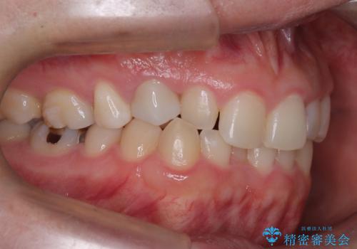 マウスピースで歯並びを改善の治療前