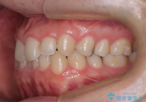 マウスピースで歯並びを改善の治療前