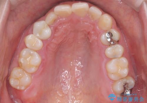 マウスピースで歯並びを改善の治療前