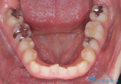 マウスピースで歯並びを改善の治療前