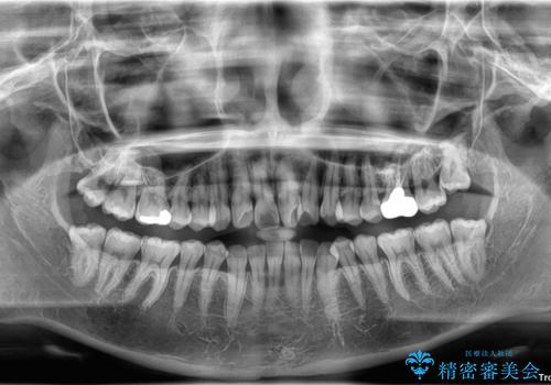 前歯のねじれ・ガタガタを10か月で改善!20代女性の矯正治療|クリアブラケットでむし歯になりにくい歯並びへ改善の治療前