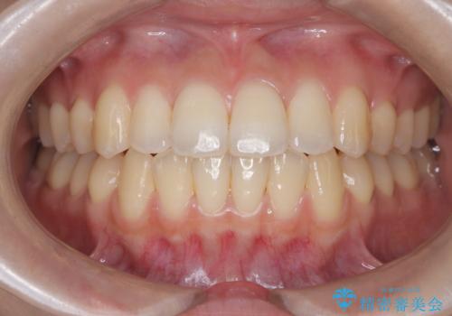 前歯のデコボコと突出を、目立たない矯正で解消の症例 治療後