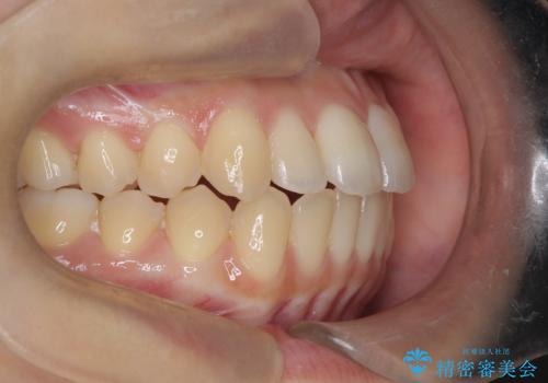 前歯のデコボコと突出を、目立たない矯正で解消の治療後