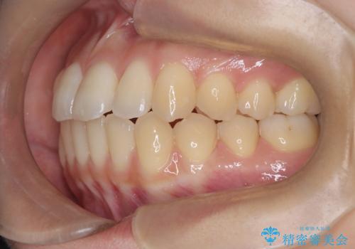 前歯のデコボコと突出を、目立たない矯正で解消の治療後