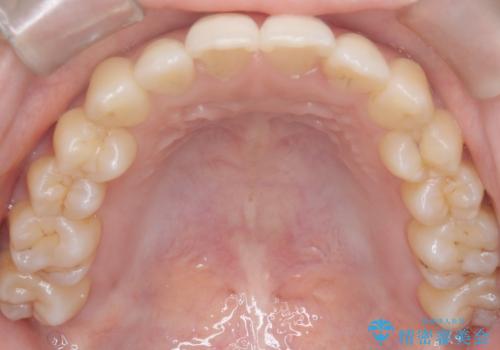 前歯のデコボコと突出を、目立たない矯正で解消の治療後