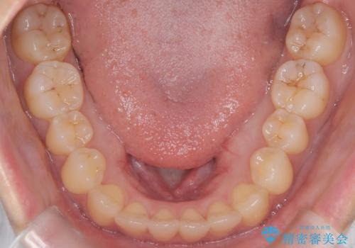 前歯のデコボコと突出を、目立たない矯正で解消の治療後