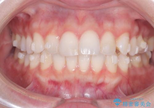 左の八重歯を、目立たないマウスピース矯正で改善の治療中