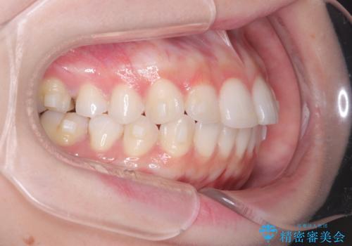 左の八重歯を、目立たないマウスピース矯正で改善の治療中