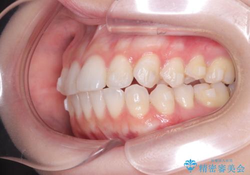 左の八重歯を、目立たないマウスピース矯正で改善の治療中