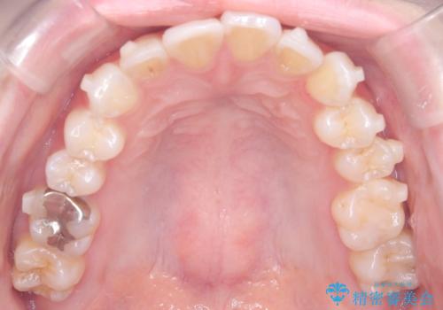 左の八重歯を、目立たないマウスピース矯正で改善の治療中