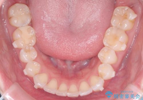 左の八重歯を、目立たないマウスピース矯正で改善の治療中