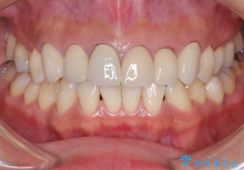 前歯の破折も1日で解決!抜歯即時インプラントで自然な笑顔への症例 治療前