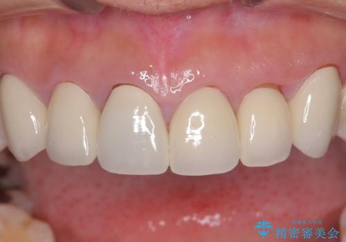 前歯の破折も1日で解決!抜歯即時インプラントで自然な笑顔への治療前