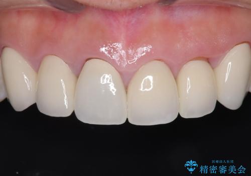 前歯の破折も1日で解決!抜歯即時インプラントで自然な笑顔への治療前