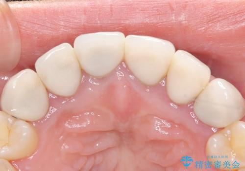 前歯の破折も1日で解決!抜歯即時インプラントで自然な笑顔への治療前