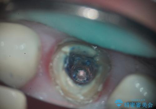 前歯の破折も1日で解決!抜歯即時インプラントで自然な笑顔への治療前
