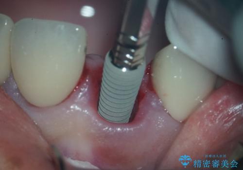 前歯の破折も1日で解決!抜歯即時インプラントで自然な笑顔へ