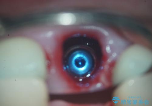 前歯の破折も1日で解決!抜歯即時インプラントで自然な笑顔への治療中