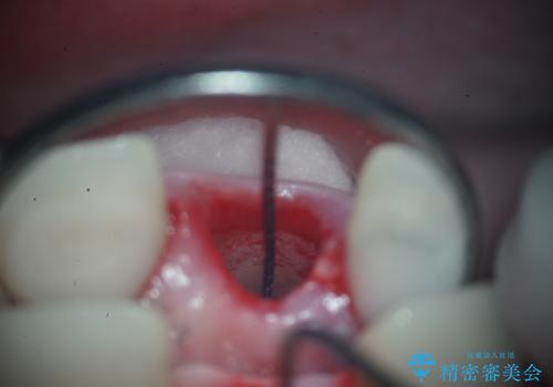 前歯の破折も1日で解決!抜歯即時インプラントで自然な笑顔への治療後