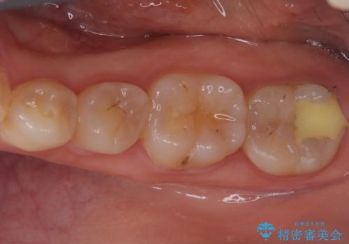 奥歯の激しい痛みを解消し、歯を長持ちさせる精密治療の症例 治療前
