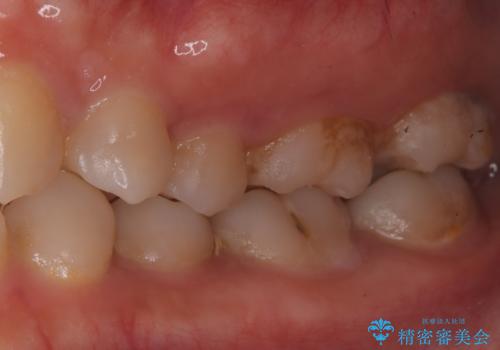 奥歯の激しい痛みを解消し、歯を長持ちさせる精密治療の治療前