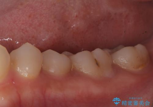 奥歯の激しい痛みを解消し、歯を長持ちさせる精密治療の治療前